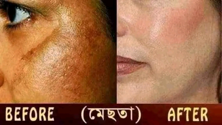 active mesta and spot out cream